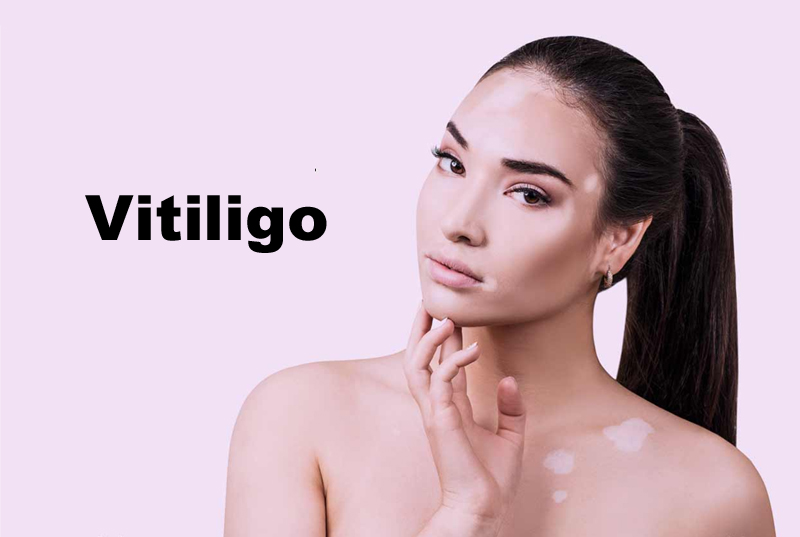 Vitiligo Treatment