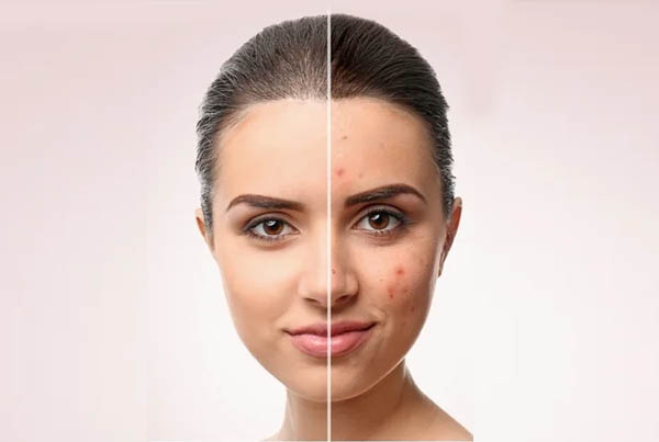 Laser Solutions for Acne