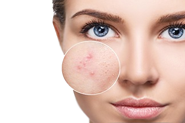 Acne Scar Removal