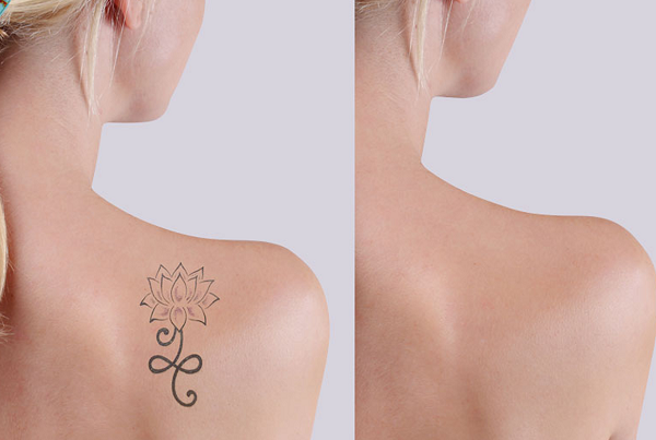 Laser Tattoo Removal